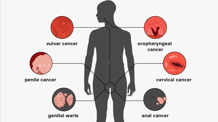 ویروس HPV برای مردان