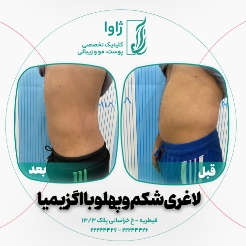 دستگاه لاغری اگزیمیا