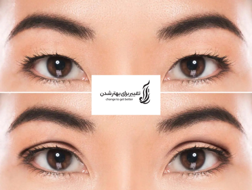 نمونه جراحی بلفاروپلاستی