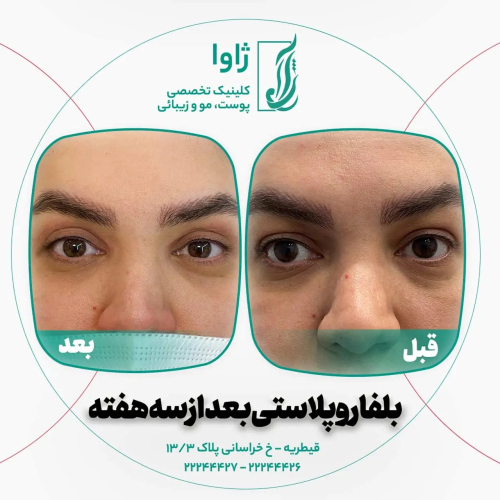 نمونه قبل و بعد جراحی بلفاروپلاستی